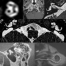 Image of Temoral bone imaging