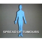 Spread of Tumours