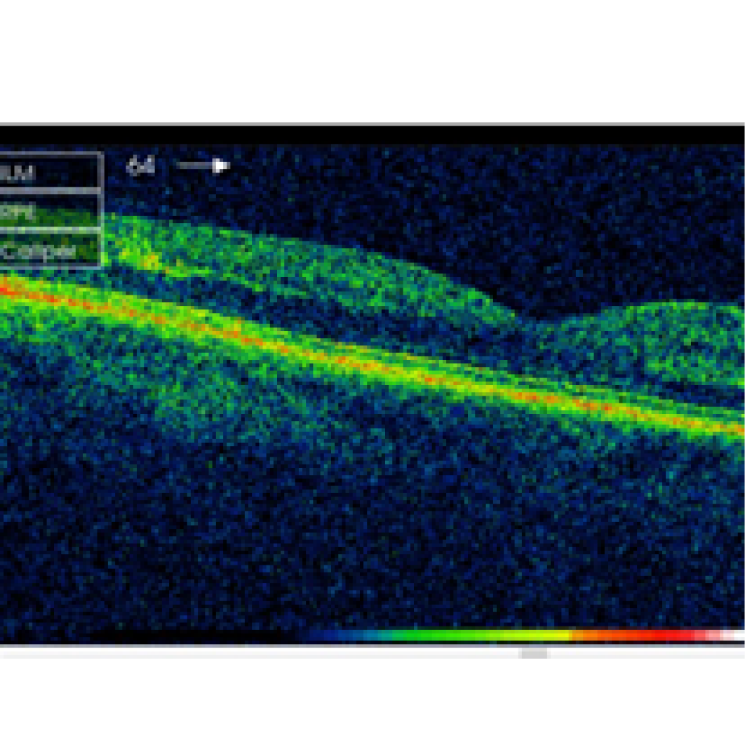 Optical Coherence Tomography (OCT) Interpretation