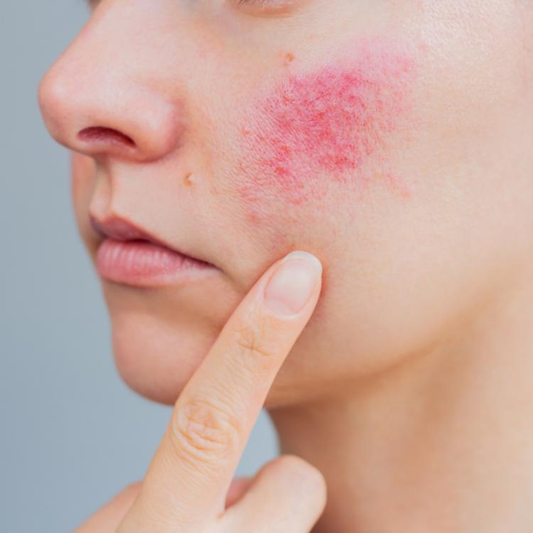 Rosacea dermatology